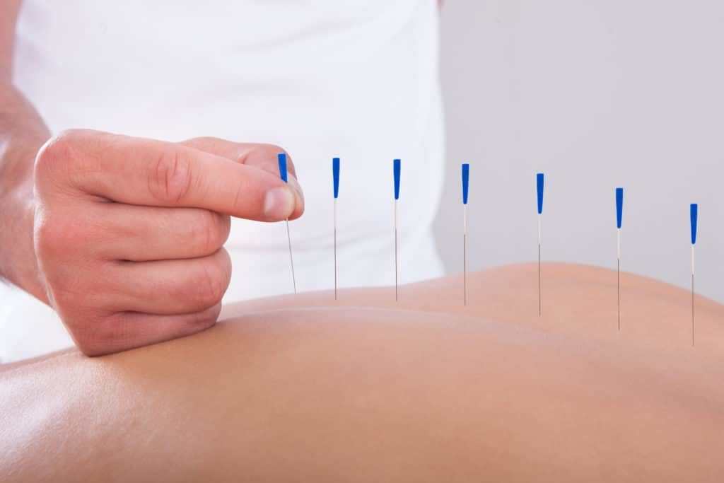 acupuncture-fertility