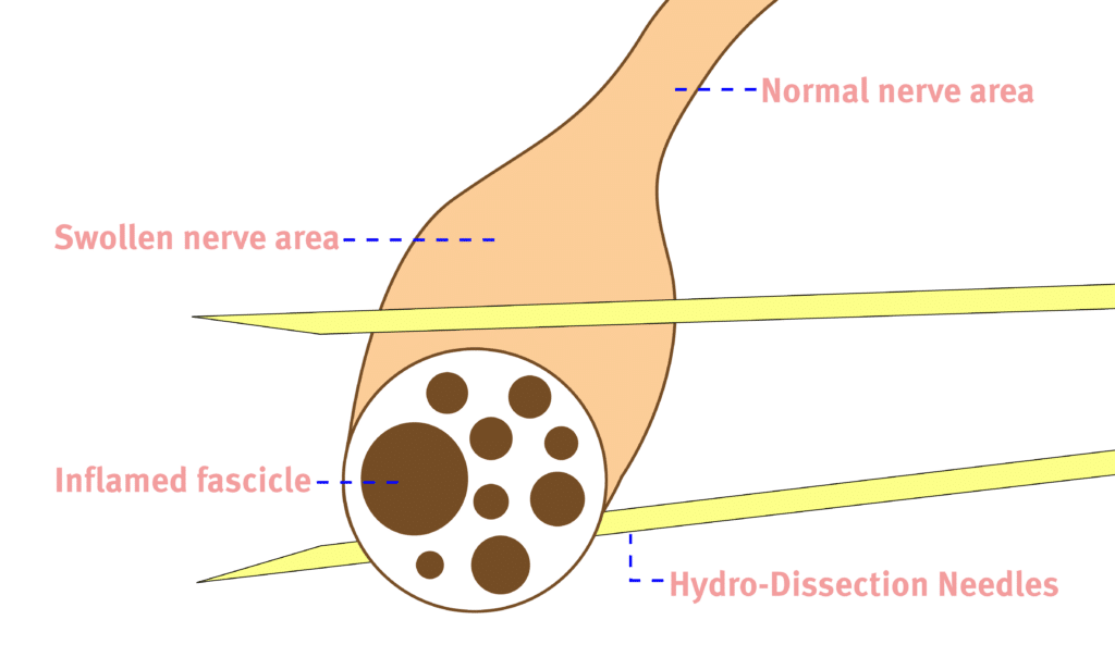 Diagram showing hydro-dissection on a nerve