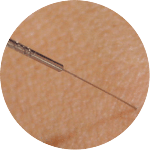 An acupuncture needle entering someone's skin
