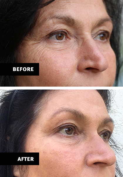 Before and after having PRP facial rejuvenation.