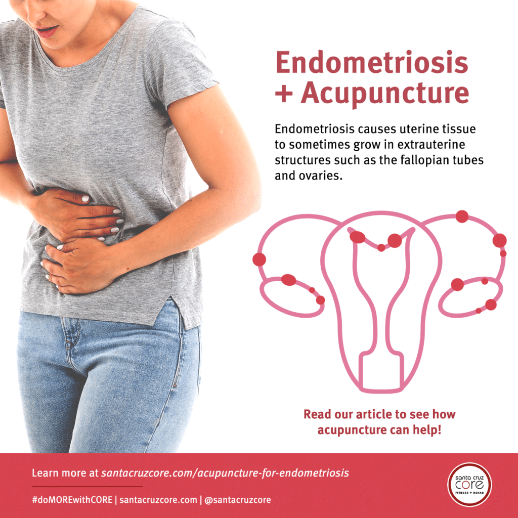 Acupuncture for endometriosis